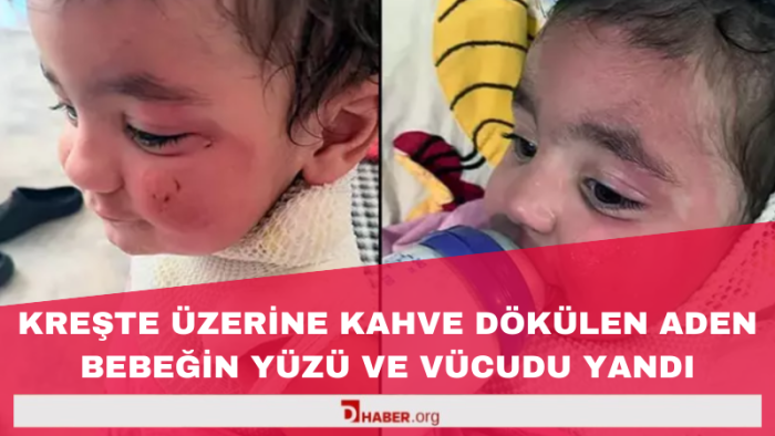 Adana'da Kreşte Kahve Dökülmesi Sonucu 1,5 Yaşındaki Aden'in Yanıkları Oluştu